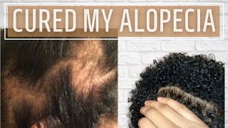 I cured my Alopecia Areata NATURALLY  No steroids No hair implants [upl. by Umberto188]