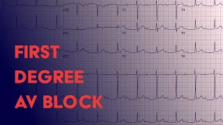 First Degree AV Block  EKG ECG Interpretation [upl. by Gerson]