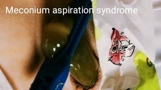 Meconium Aspiration Syndrome  Pediatrics [upl. by Okun]