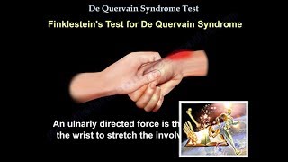 De Quervain Syndrome Test  Everything You Need To Know  Dr Nabil Ebraheim [upl. by Knipe]