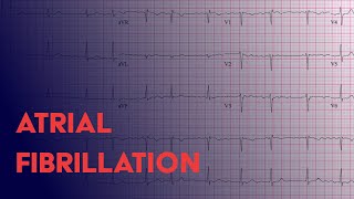 Atrial Fibrillation Afib  EKG ECG Interpretation [upl. by Ardnauqal]