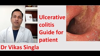 Ulcerative colitis Treatment and Symptoms अल्सरेटिव कोलाइटिस In Hindi Dr Vikas Singla [upl. by Tnaryb]