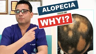 What is Alopecia areata  Causes Diagnosis amp Hair Regrowth Treatments skinqure in Hindi [upl. by Cammy]