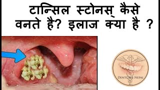 Tonsil Stones  Tonsilloliths Causes and Treatment  IN HINDI [upl. by Reilly]