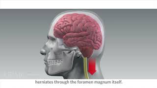 Chiari Malformation amp Syringomyelia [upl. by Eimyaj]