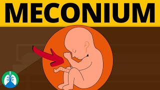 Meconium Aspiration Syndrome Medical Definition  Quick Explainer Video [upl. by Tare]