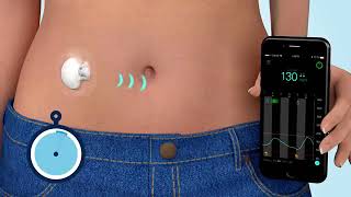 What is Continuous Glucose Monitoring CGM [upl. by Nirrad]