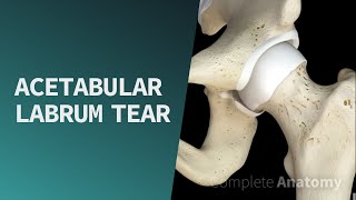 Acetabular Labrum Tear  Pathologies [upl. by Sheelagh]