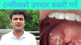 Tonsillitis in NepaliDeepak Poudeldoctor sathi [upl. by Howarth]