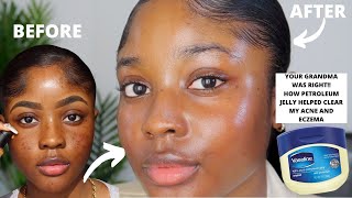 HOW VASELINE HELPED CLEAR MY ACNE AND EZCEMA FASTER  KAISERCOBY [upl. by Bushore]