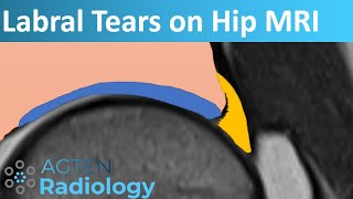 Labral Tears on Hip MRI [upl. by Wilt]