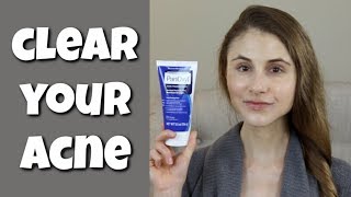 HOW TO CLEAR YOUR SKIN WITH BENZOYL PEROXIDE DR DRAY [upl. by Tlevesoor453]