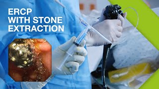 ERCP Practical Guide I Part 2 ERCP with Stone Extraction [upl. by Sokcin]