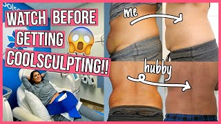 SHOCKING Coolsculpting Before amp After 6 Things You NEED to Know [upl. by Hahnke]