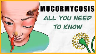 Mucormycosis microbiology types signs amp symptoms diagnosis treatment [upl. by Goebel]