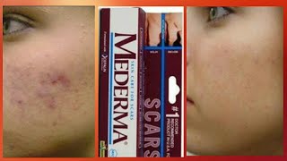 Mederma skin cream review  Scar ointment gel Mederma [upl. by Nylsej]