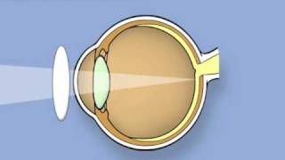 A Stem CellBased Therapy for Retinitis Pigmentosa [upl. by Leahcimal]