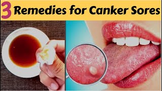 How to Get Rid of Blisters on the Tongue  Home Remedies for Mouth Ulcers [upl. by Agate108]