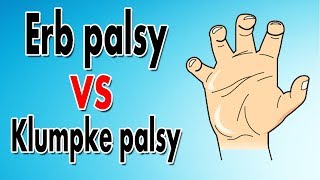 Erbs Palsy vs Klumpkes Palsy [upl. by Golanka]