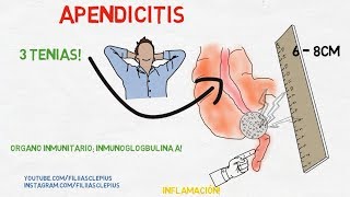 Apendicitis  Cirugía Signos y síntomas  Escala de Alvarado [upl. by Elbag145]