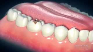 Dental Crowns Everything You Need to Know [upl. by Zoe]