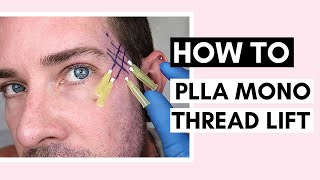 PLLA Mono Thread Lift On Temples  Technique Tips amp How To Insert Threads Ft Vanidiy [upl. by Tal]