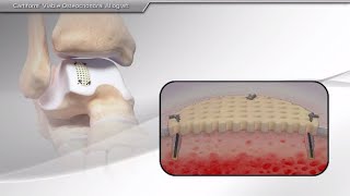 Cartiform® Viable Osteochondral Allograft [upl. by Ng]