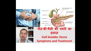 Gall bladder stone symptoms treatment in Hindi By Dr Vikas Singla [upl. by Ardekan]