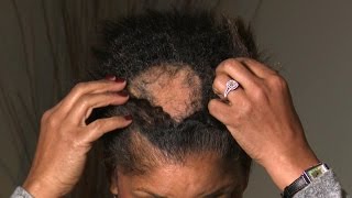 What Is Causing This Woman’s Extreme Hair Loss [upl. by Dame512]