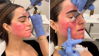 Getting the Vampire Facial 💉 You gotta see these results [upl. by Anilrahc]