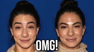 BOTOX BEFORE AND AFTER [upl. by Rialb]