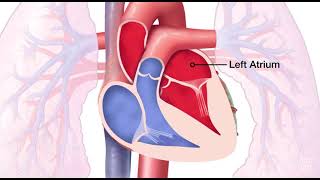 Mitral Valve Regurgitation [upl. by Robillard825]