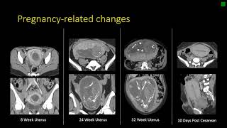 Gynecologic Radiology Anatomy [upl. by Dorweiler]