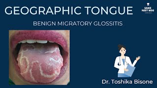 Geographic tongue  Benign migratory glossitis [upl. by Rekrap681]