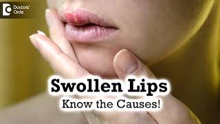 Swollen Lips Common CausesTriggers  Angioedema  Dr Rashmi Ravindra  Doctors Circle [upl. by Mariejeanne]