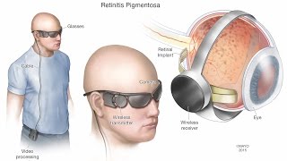 Macular Hole Vitrectomy Surgery [upl. by Elliott]