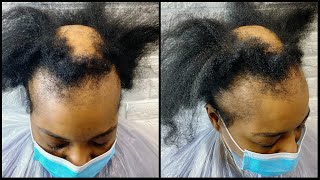 Alopecia Hair Makeover  How To Cover Bald Spots For Women  Alopecia Hair Transformation [upl. by Sibelle]