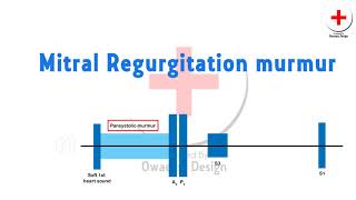 Mitral regurgitation murmur [upl. by Ziza]