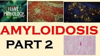 Cardiac Amyloidosis by Dr Mat Maurer [upl. by Bever]