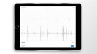 Atrial Fibrillation Combined Heart Sound PCG amp ECG Example  EkoCLINIC App [upl. by Saidel]