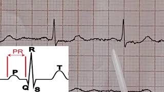 ECG Interpretation tres facile de l ECG 9eme partie Lecture d un ECG Normal [upl. by Thetis]